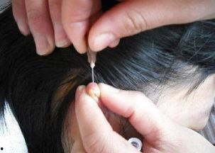 委中放血的方法视频,委中放血疗法实操视频详解