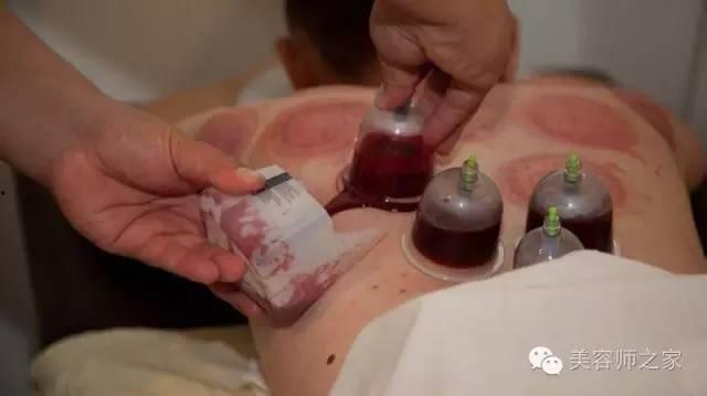 委中放血的方法视频,委中放血疗法实操视频详解