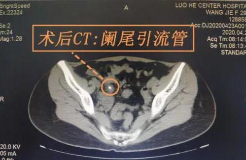 阑尾炎手术视频,从术前准备到术后恢复