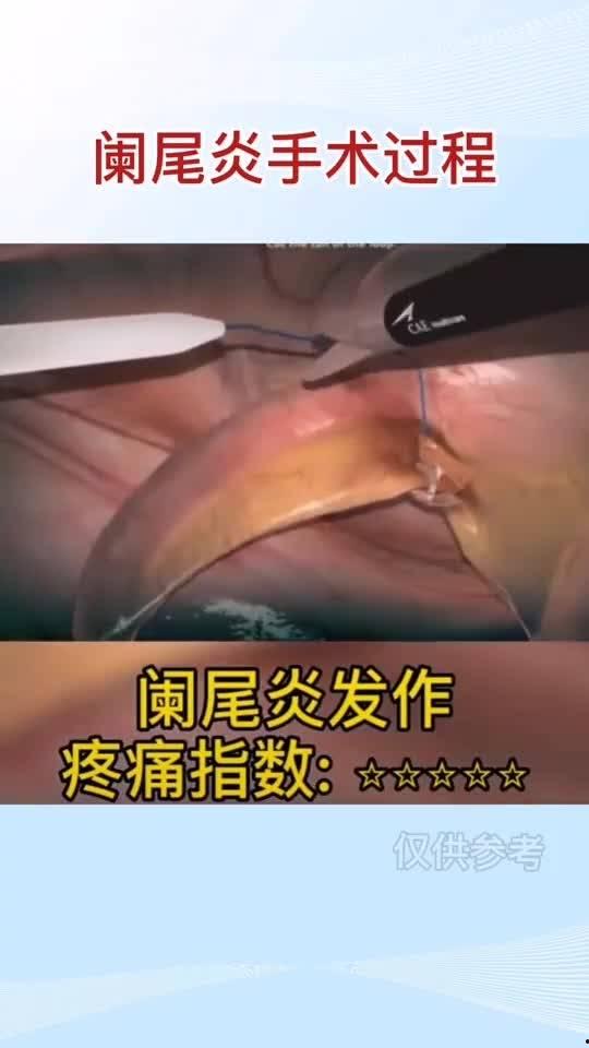 阑尾炎手术视频,从术前准备到术后恢复