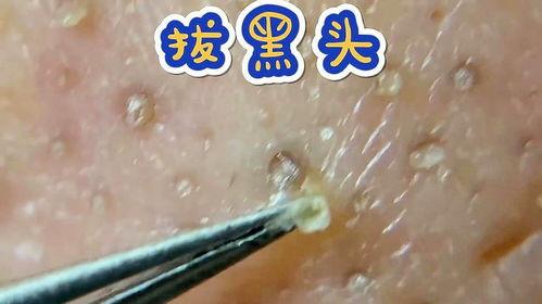 黑头 视频,深度解析皮肤问题与解决方案