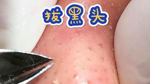 黑头 视频,深度解析皮肤问题与解决方案